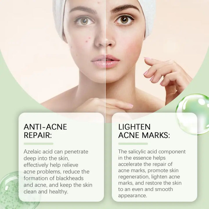 Before and after results of EELHOE Azelaic Acid Acne Care Essence – visibly reduces acne, blackheads, and lightens acne marks for smoother skin
