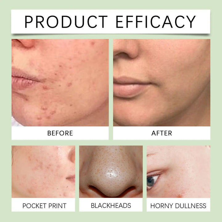 Before and after using RelaxRiser Azelaic Acid Essence – visible acne reduction, blackhead removal, and smoother skin texture